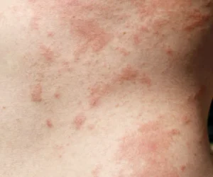 Buy Allergies online UK